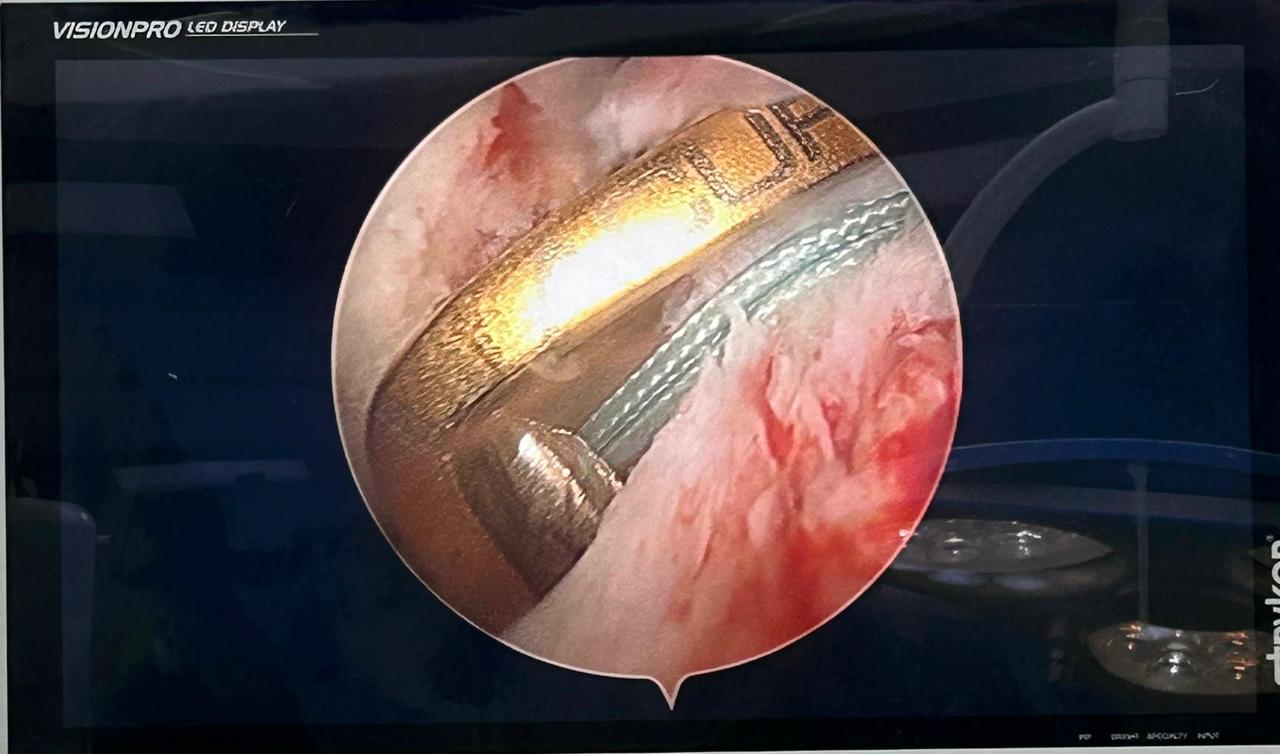 first advanced knee salvage surgery