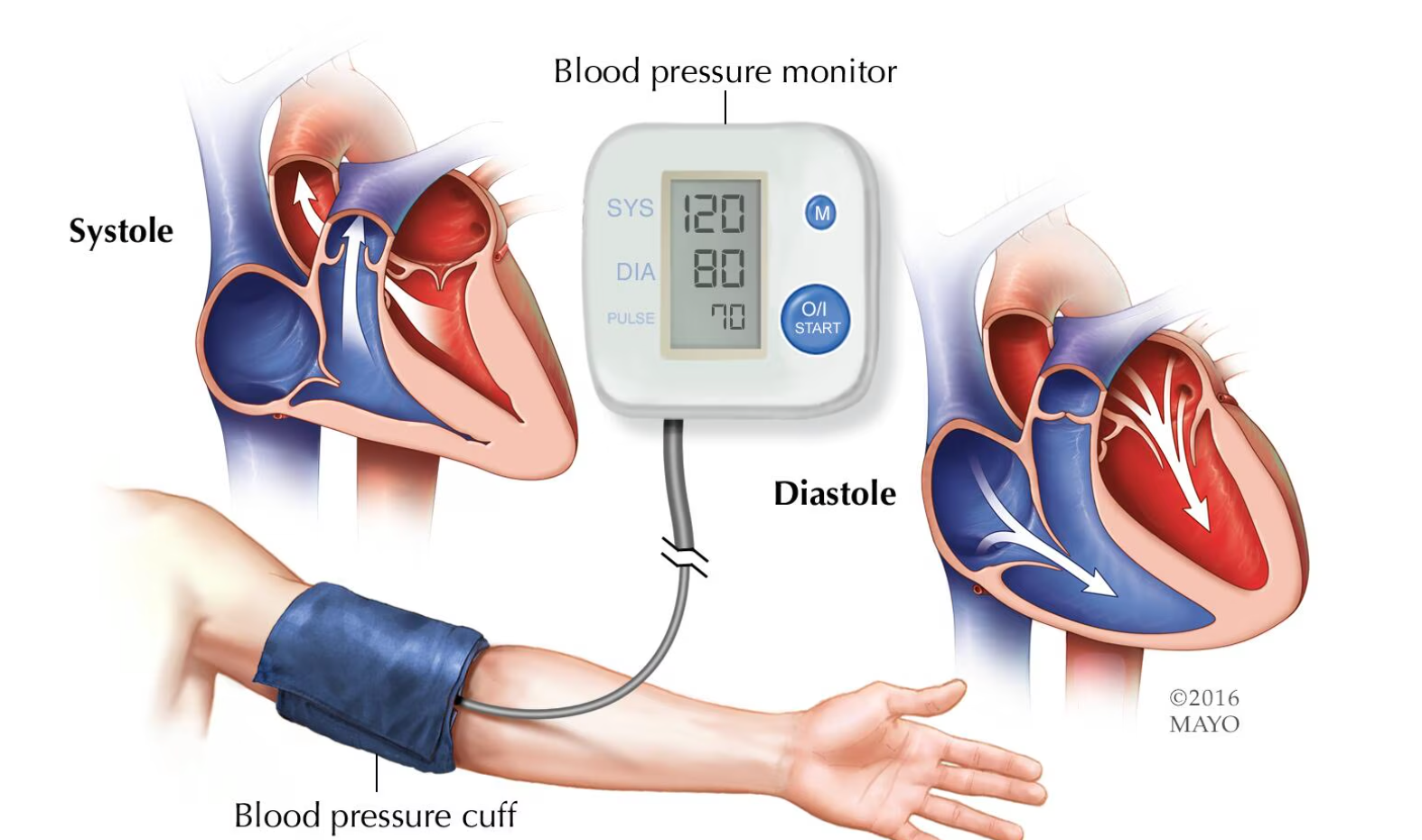 Hypertension BP