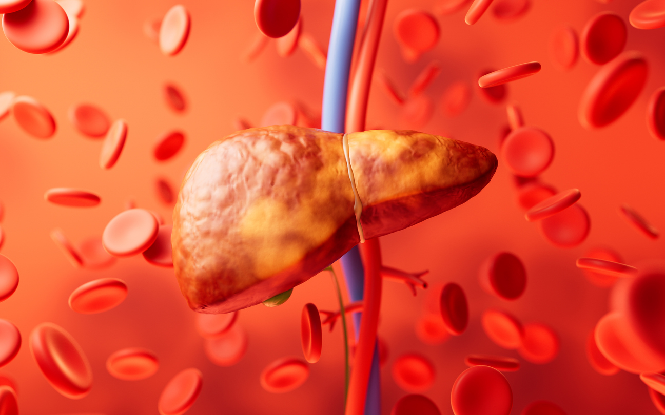 fatty liver